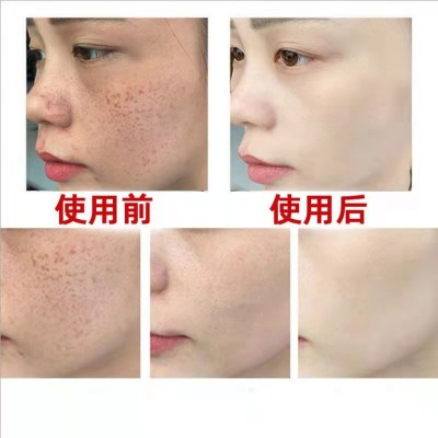 祛斑液排色液美白精华液祛淡斑保养液提亮肤色黄褐斑377vc精华液图2