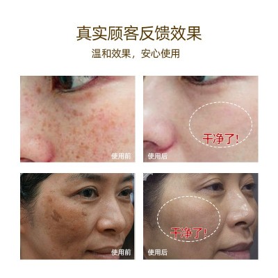 清雀素祛斑液免提取美白无尴尬雀斑老年斑提取液点斑水小样化妆品图3