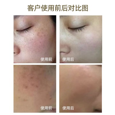 一秒擦斑液提取液雀斑老年斑点斑水无尴尬金水零结痂祛斑液化妆品图4